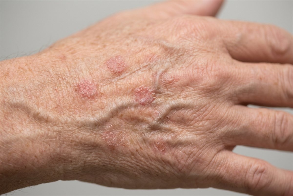 Representative clinical image of actinic keratoses — rough, scaly, pink patches on the sun-damaged back of the hand
