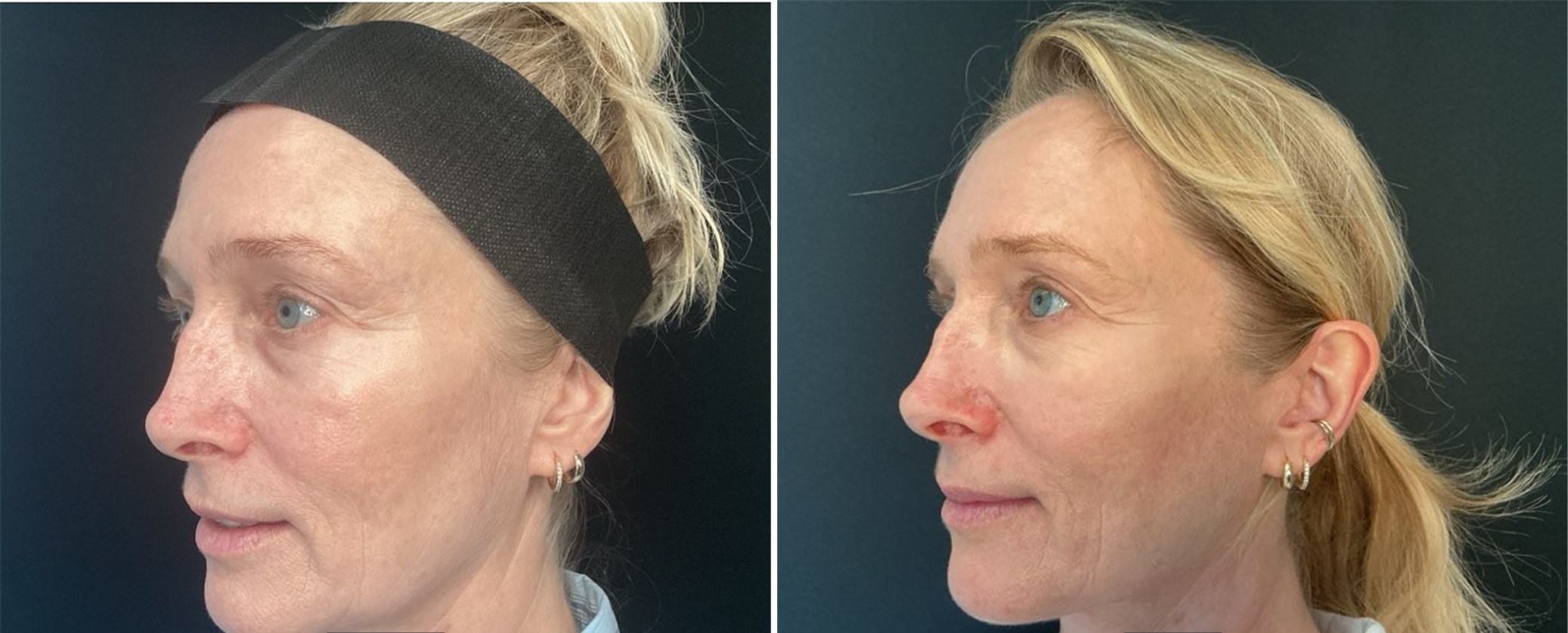 Smoother eye & cheek contour — actual Juniper patient