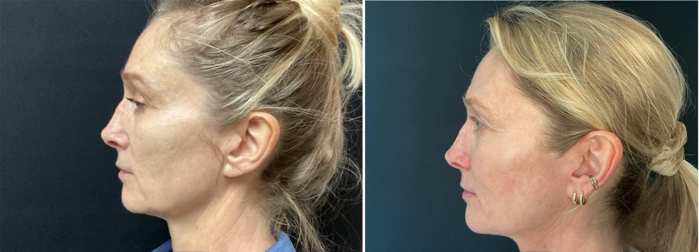 Jawline & neck tightening — actual Juniper patient