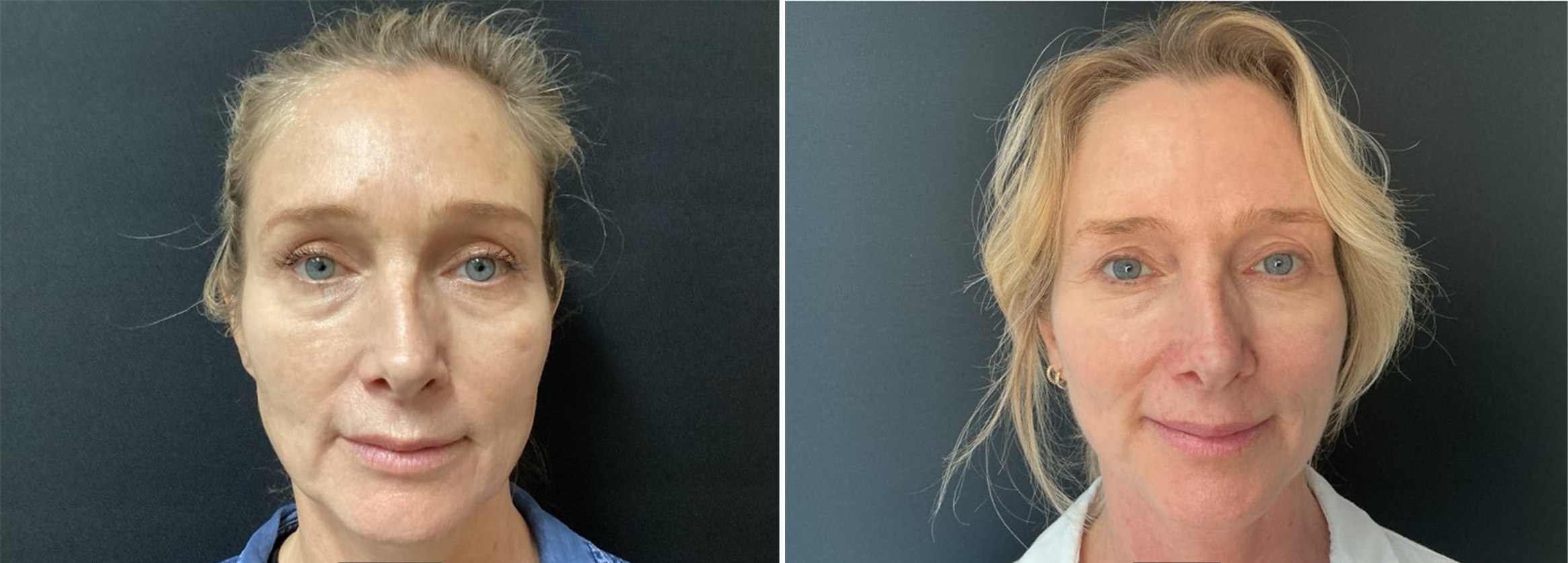 Under-eye bags reduced — actual Juniper patient
