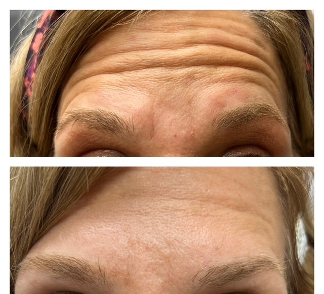 Forehead lines smoothed — actual Juniper patient