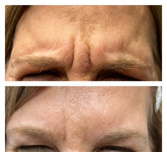 Frown lines (‘11s’) softened — actual Juniper patient