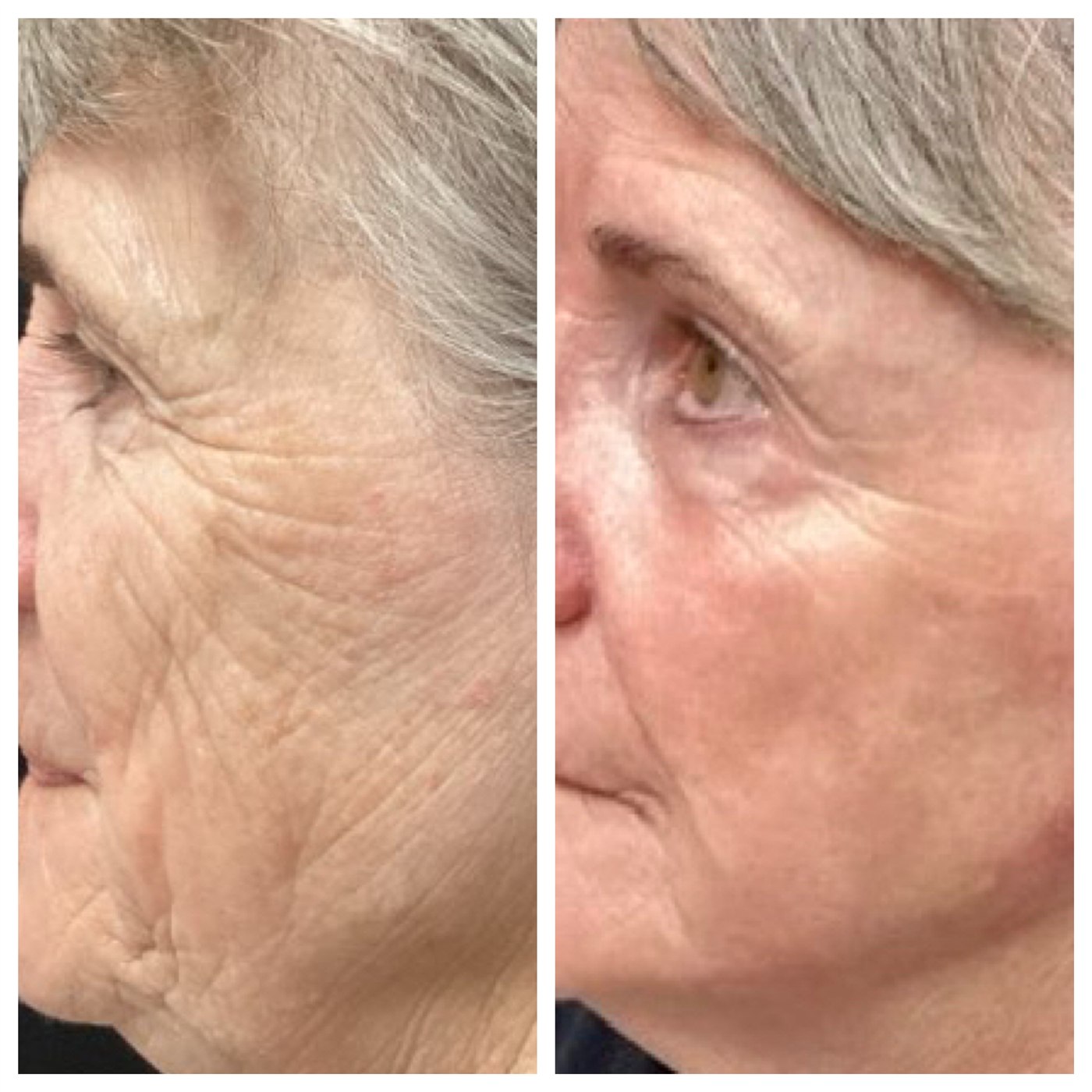 Smoother texture and softened wrinkles after CO₂ laser resurfacing — actual Juniper patient. Individual results vary.