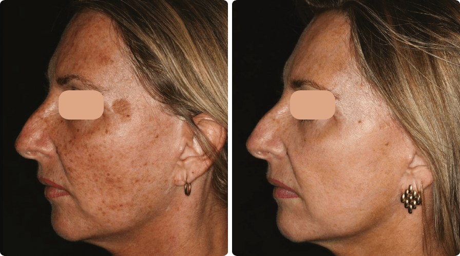 Sun damage & uneven tone resurfaced for clearer skin. Representative manufacturer clinical image (Lumenis UltraPulse®) — individual results vary.