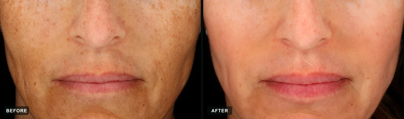 Severe melasma and diffuse sun damage visibly corrected after a cosmelan&reg; depigmentation protocol. Representative manufacturer clinical case courtesy of mesoestetic&reg;. Individual results vary.