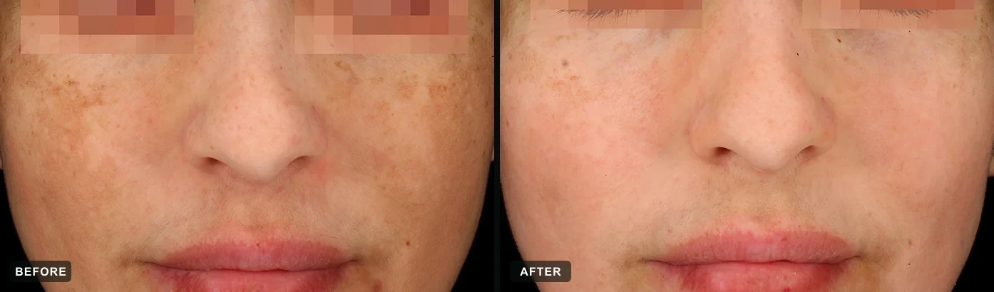 Melasma in the classic &ldquo;mask&rdquo; pattern markedly cleared after a cosmelan&reg; protocol. Representative manufacturer clinical case courtesy of mesoestetic&reg;. Individual results vary.
