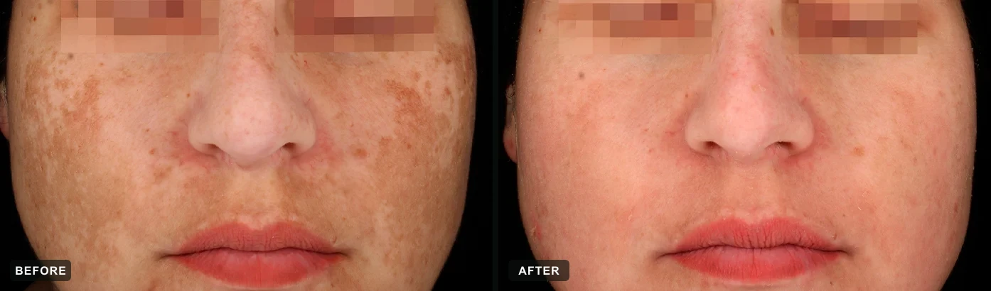 Melasma and sun-induced pigmentation visibly improved after a cosmelan&reg; protocol. Representative manufacturer clinical case courtesy of mesoestetic&reg;. Individual results vary.