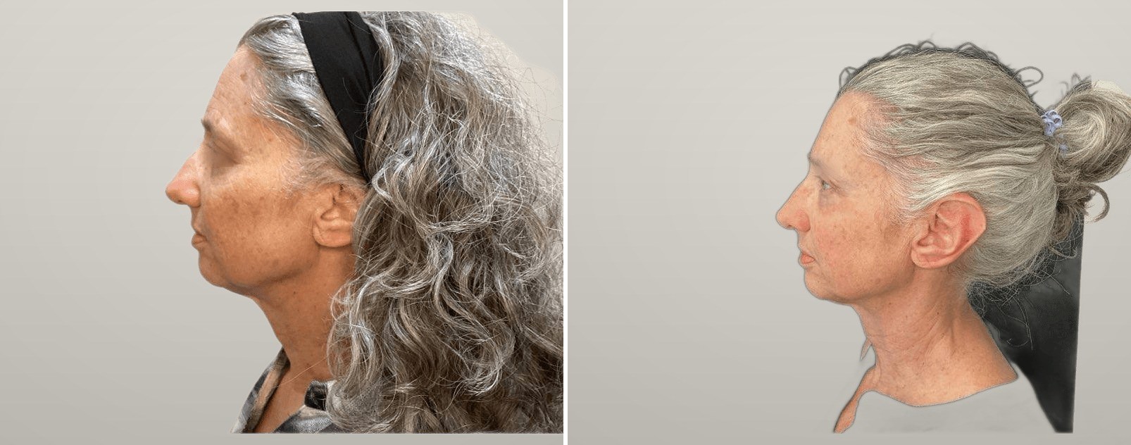 Erbium laser resurfacing — smoother, clearer skin from the opposite side. Actual Juniper patient; eyes anonymized at the patient's request. Individual results vary.