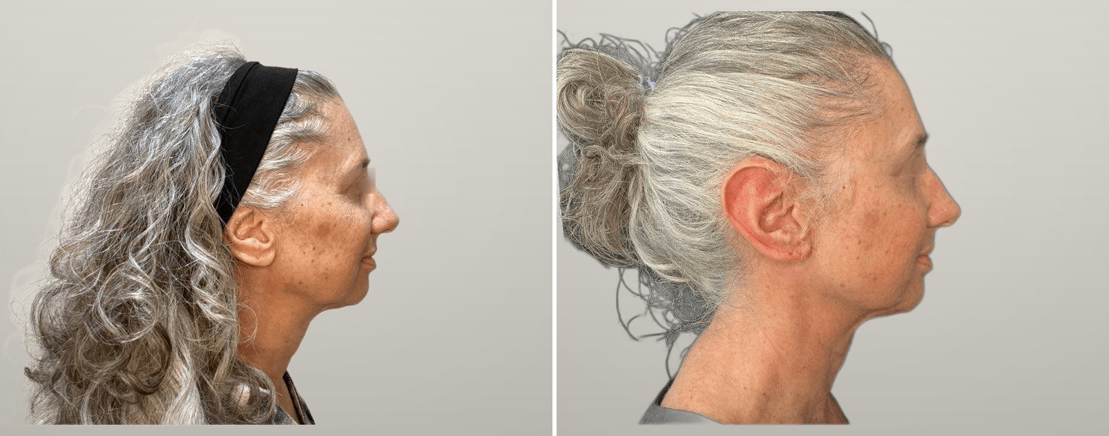 Erbium laser resurfacing — reduced sun spots and more even tone. Actual Juniper patient; eyes anonymized at the patient's request. Individual results vary.