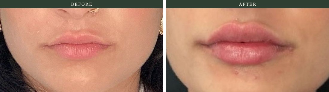 Lip filler — subtle, balanced volume. Actual Juniper Dermatology patient; individual results vary.