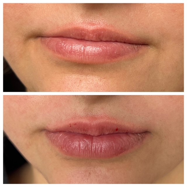 Lip filler with refreshed lower face — actual Juniper patient