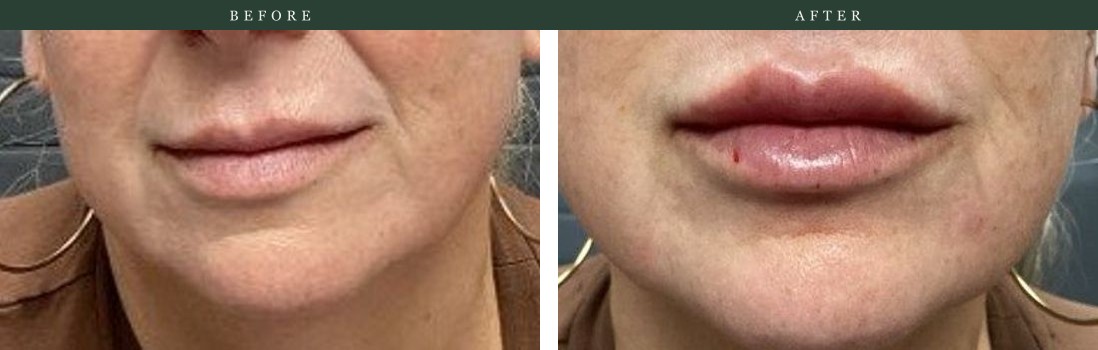 Lip filler — added fullness and definition in balance with the lower face. Actual Juniper Dermatology patient; individual results vary.