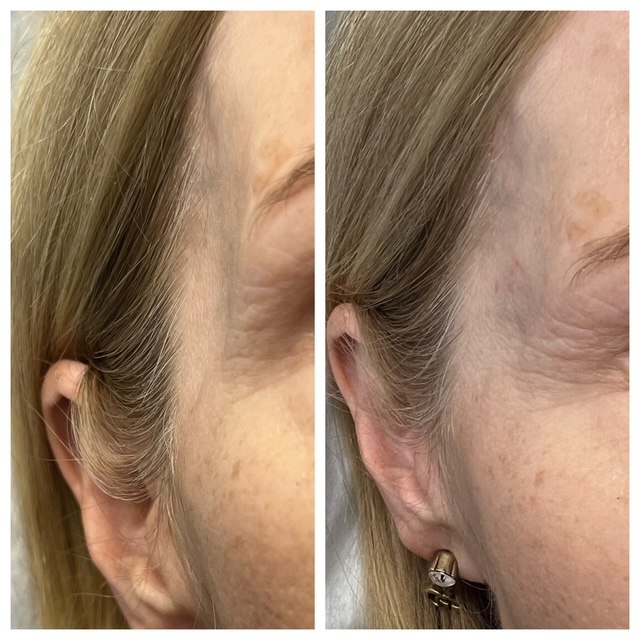 Lip enhancement — natural volume, actual Juniper patient