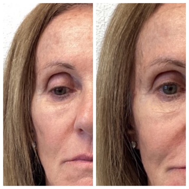 Under-eye / tear trough restored — actual Juniper patient