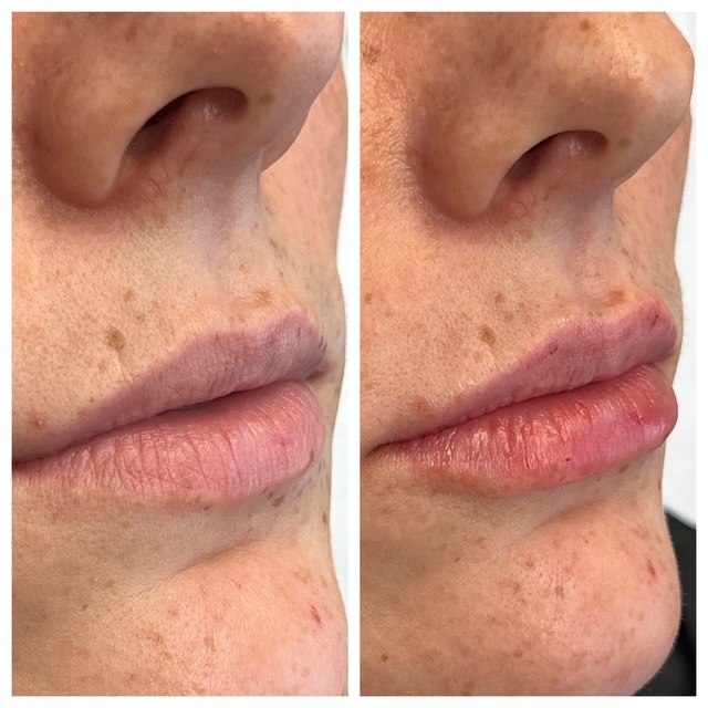 Under-eye volume restored — actual Juniper patient