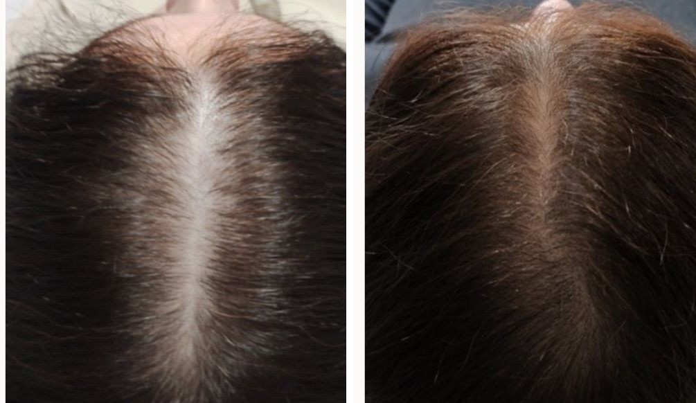 Folix laser hair regrowth before and after - Central part - after 4 Folix® sessions