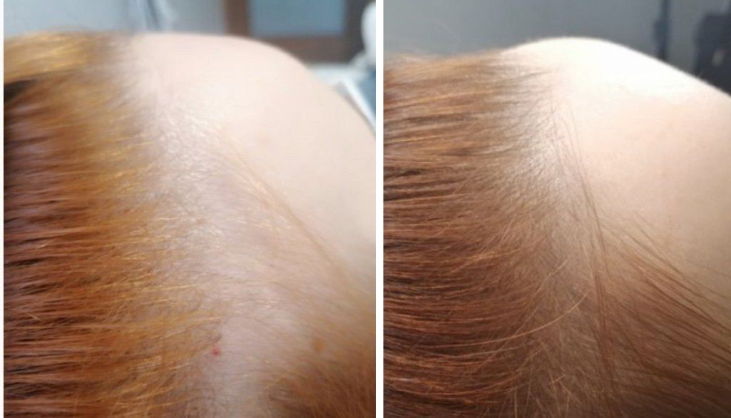 Folix laser hair regrowth before and after - Widening part - after 3 Folix® sessions