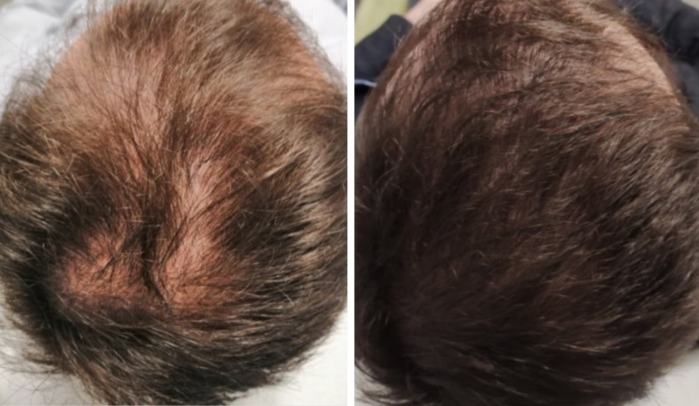 Folix laser hair regrowth before and after - Crown thinning - after 4 Folix® sessions