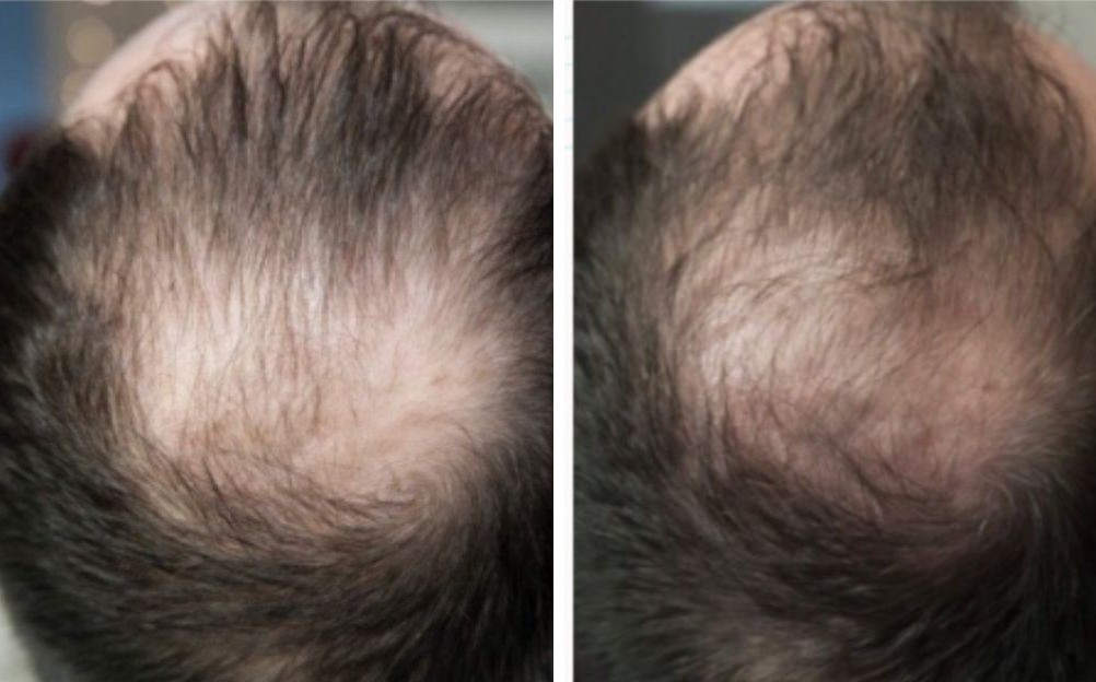 Folix laser hair regrowth before and after - Crown thinning - after 3 Folix® sessions