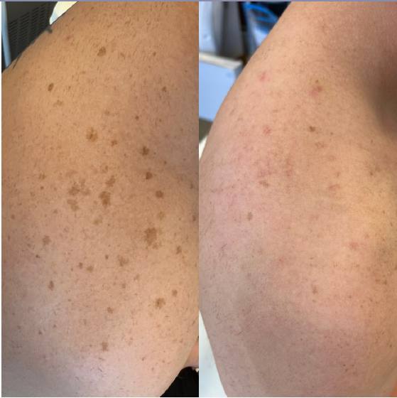 Sun spots on the back & shoulders visibly cleared — actual Juniper patient. Individual results vary.