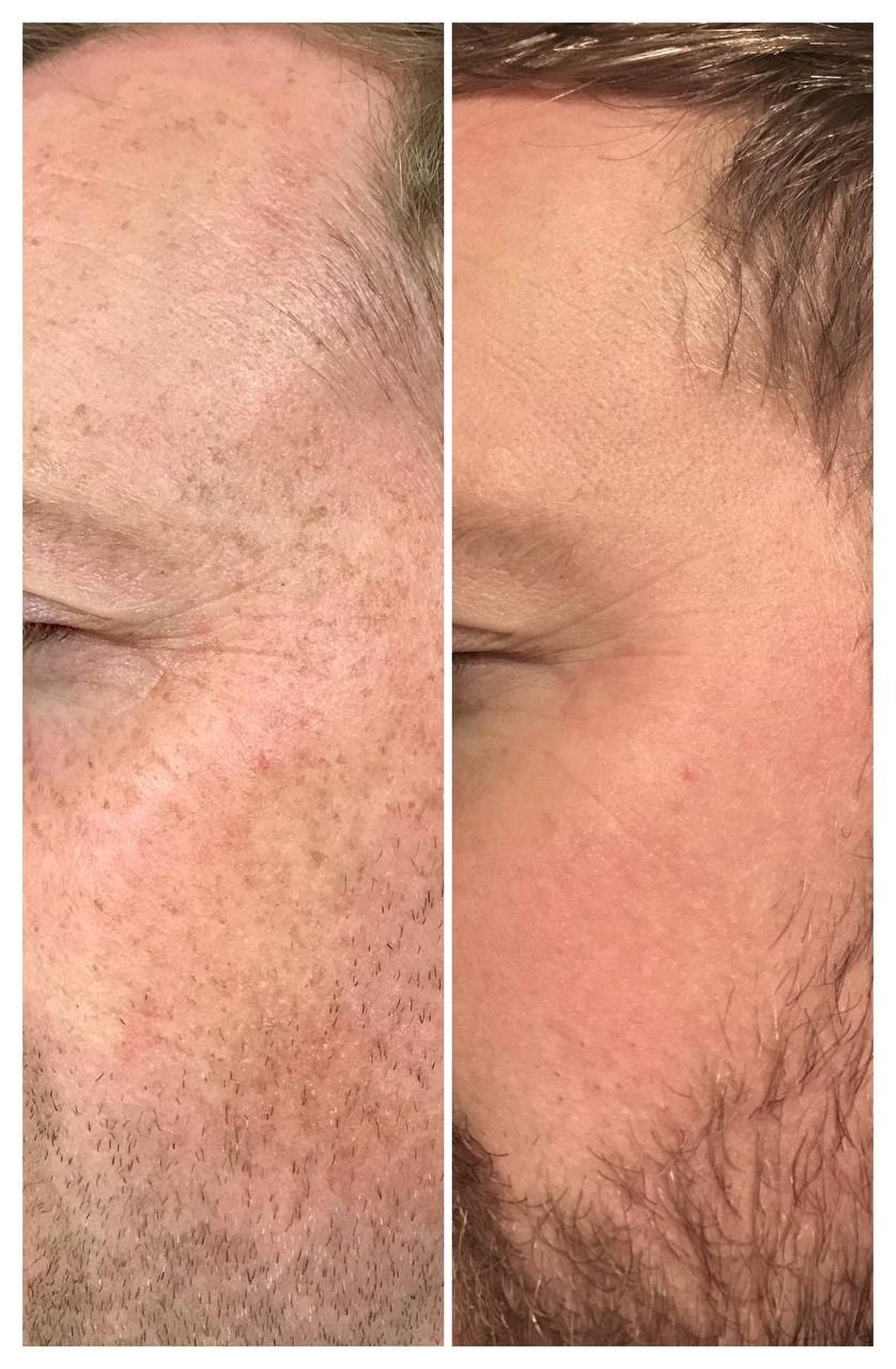 Sun spots & brown patches lifted for a clearer, more even complexion after IPL. Representative manufacturer clinical image (LUVO Lucent&trade;) — individual results vary.