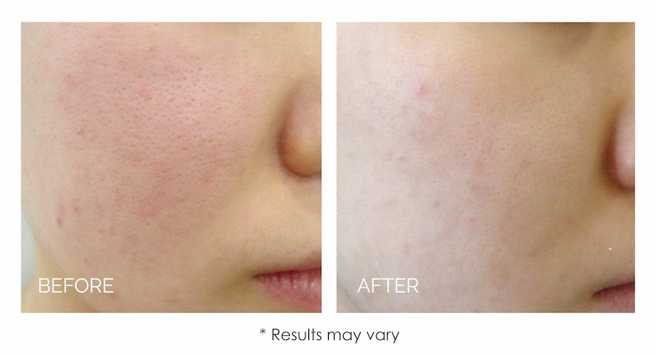 Facial redness & flushing visibly calmed with IPL. Representative manufacturer clinical image (LUVO Lucent&trade;) — individual results vary.