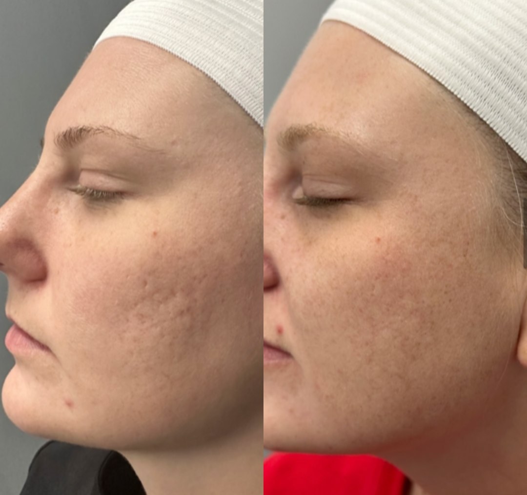 Acne scarring & skin texture visibly refined after RF microneedling. Representative manufacturer clinical image (Pixel8-RF&trade;, courtesy Rohrer Aesthetics) — individual results vary.