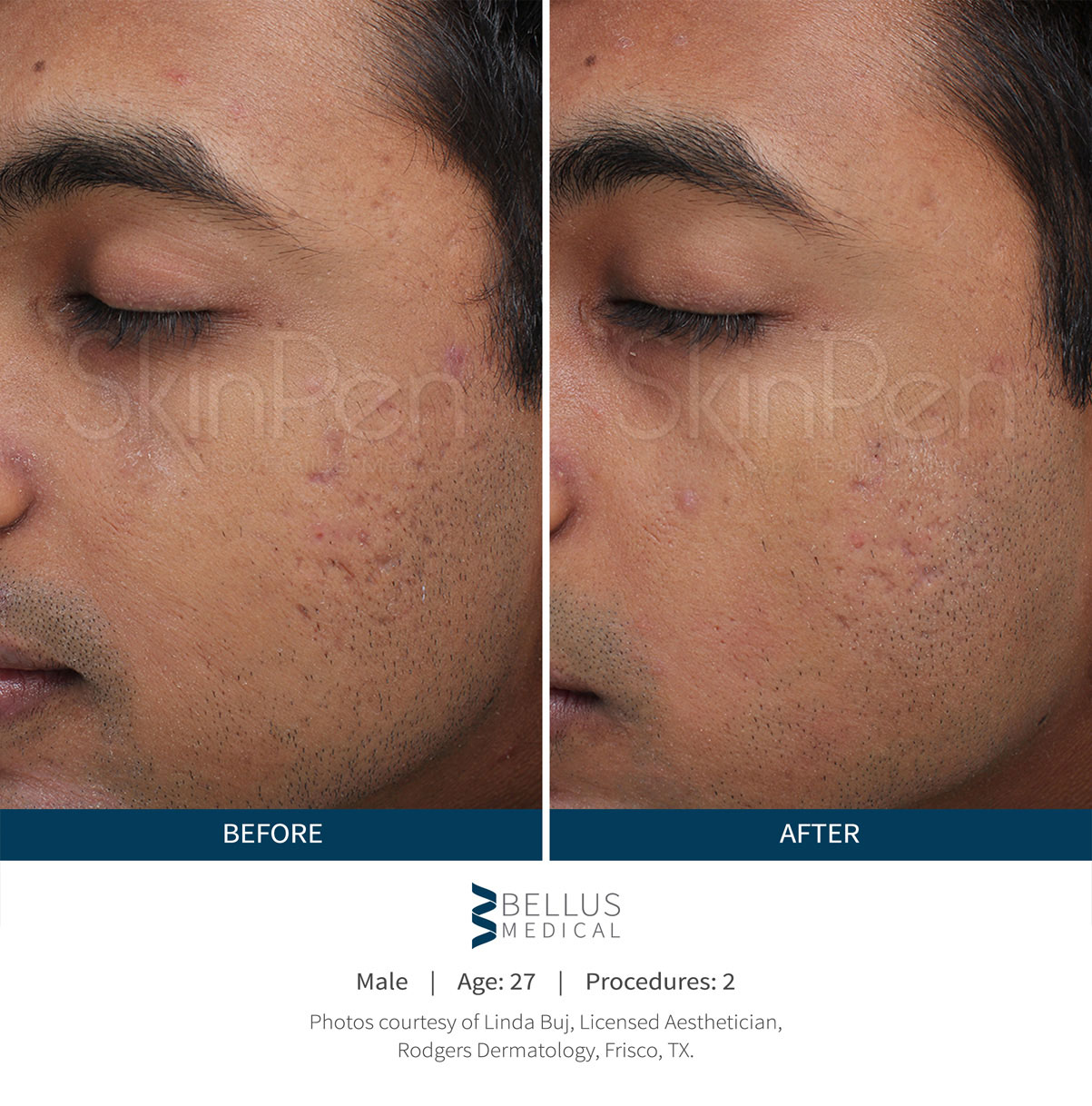 A PRP (&ldquo;Vampire Facial&rdquo;) pairs platelet-rich plasma with SkinPen® microneedling (Crown Aesthetics). Representative manufacturer clinical image; not a Juniper patient. Individual results vary.
