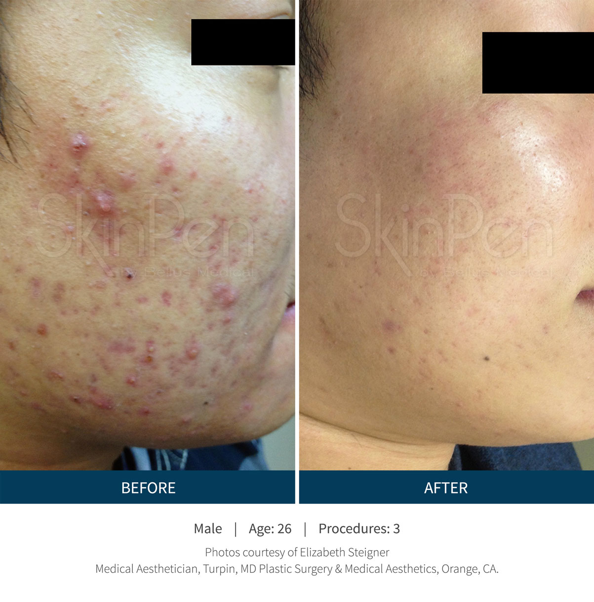 Acne and post-acne texture improved after PRP-supported microneedling with SkinPen® (Crown Aesthetics). Representative manufacturer clinical image; not a Juniper patient. Individual results vary.