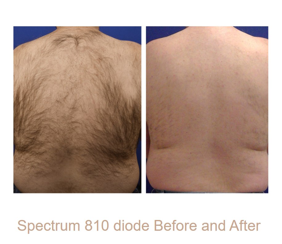 Back hair reduction with the Spectrum 810 nm diode. Representative manufacturer clinical image; not a Juniper patient. Individual results vary.