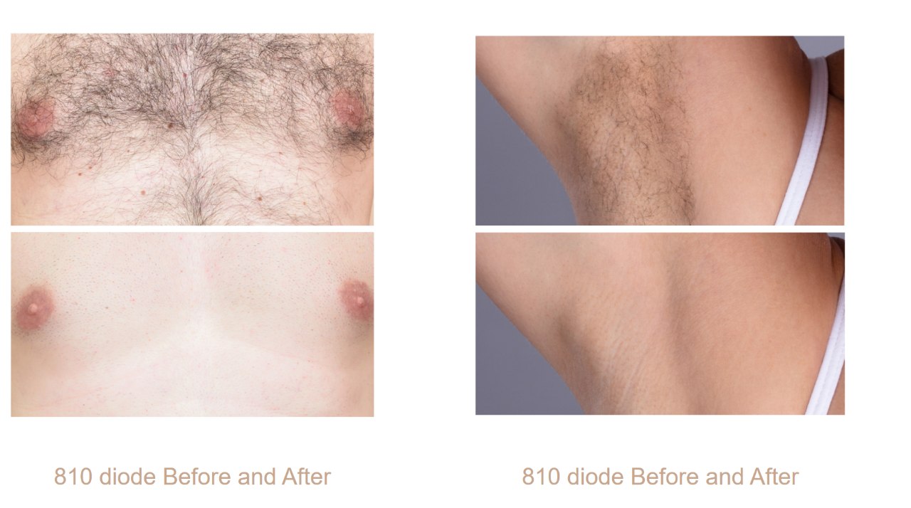 Chest and underarm hair reduction with the Spectrum 810 nm diode. Representative manufacturer clinical images; not Juniper patients. Individual results vary.