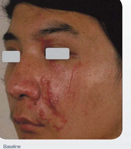 Scar Revision before treatment at Juniper Dermatology