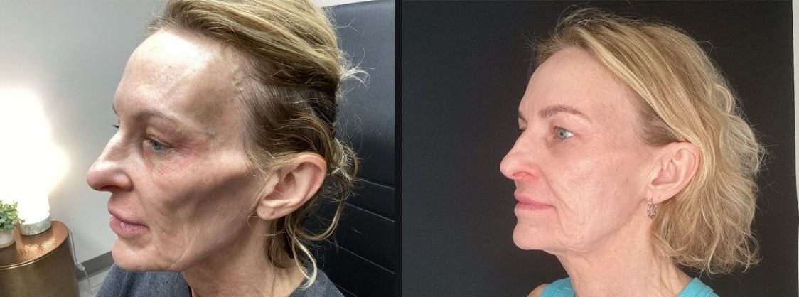Sculptra® collagen restoration — actual Juniper Dermatology patient; individual results vary