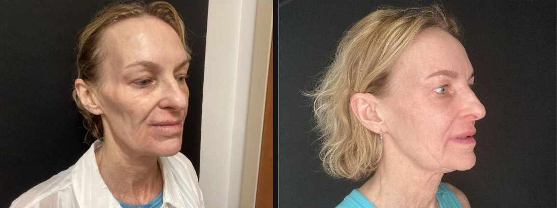 Three-quarter view &mdash; fuller cheeks and a refreshed contour after a Sculptra&reg; series. Actual Juniper Dermatology patient; individual results vary.