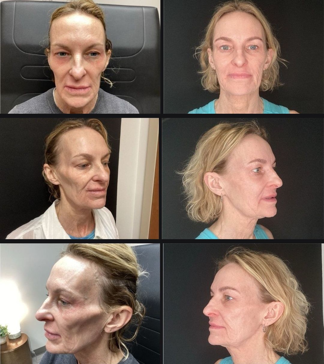 Front, three-quarter & profile views — restored midface volume, fuller cheeks, and softer folds after a Sculptra® series. Actual Juniper Dermatology patient; individual results vary.