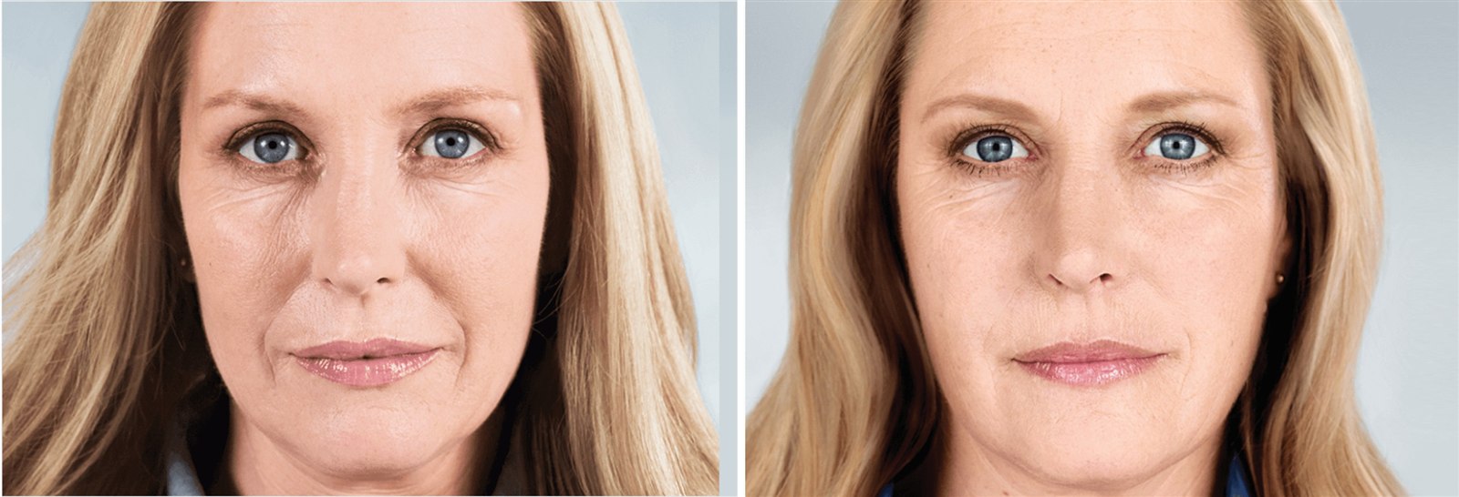 Gradual restoration of facial volume & fullness after a Sculptra® series. Representative manufacturer clinical image (Sculptra®, Galderma) — individual results vary.