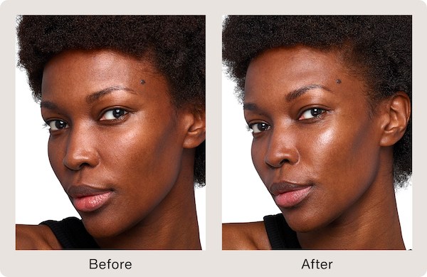 Smoother, more hydrated, luminous cheeks after SkinVive&trade;. Representative clinical image (SkinVive&trade; by Juv&eacute;derm®) — individual results vary.