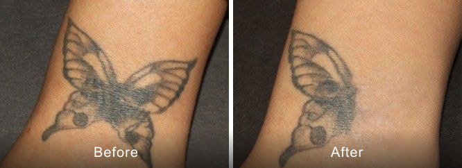 Progressive fading of a tattoo across a series of laser sessions. Representative clinical image — individual results vary.