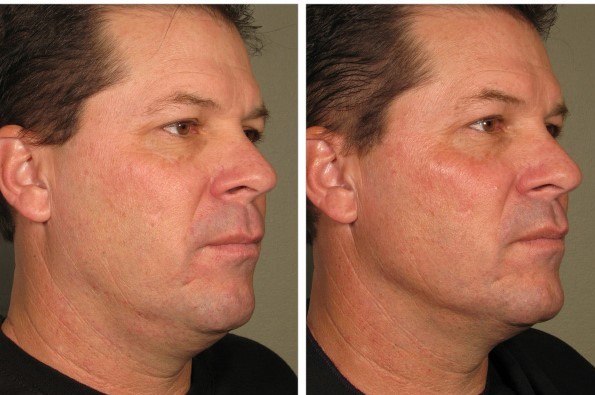Non-surgical lift along the jaw & neck after Ultherapy®. Manufacturer clinical image — individual results vary.