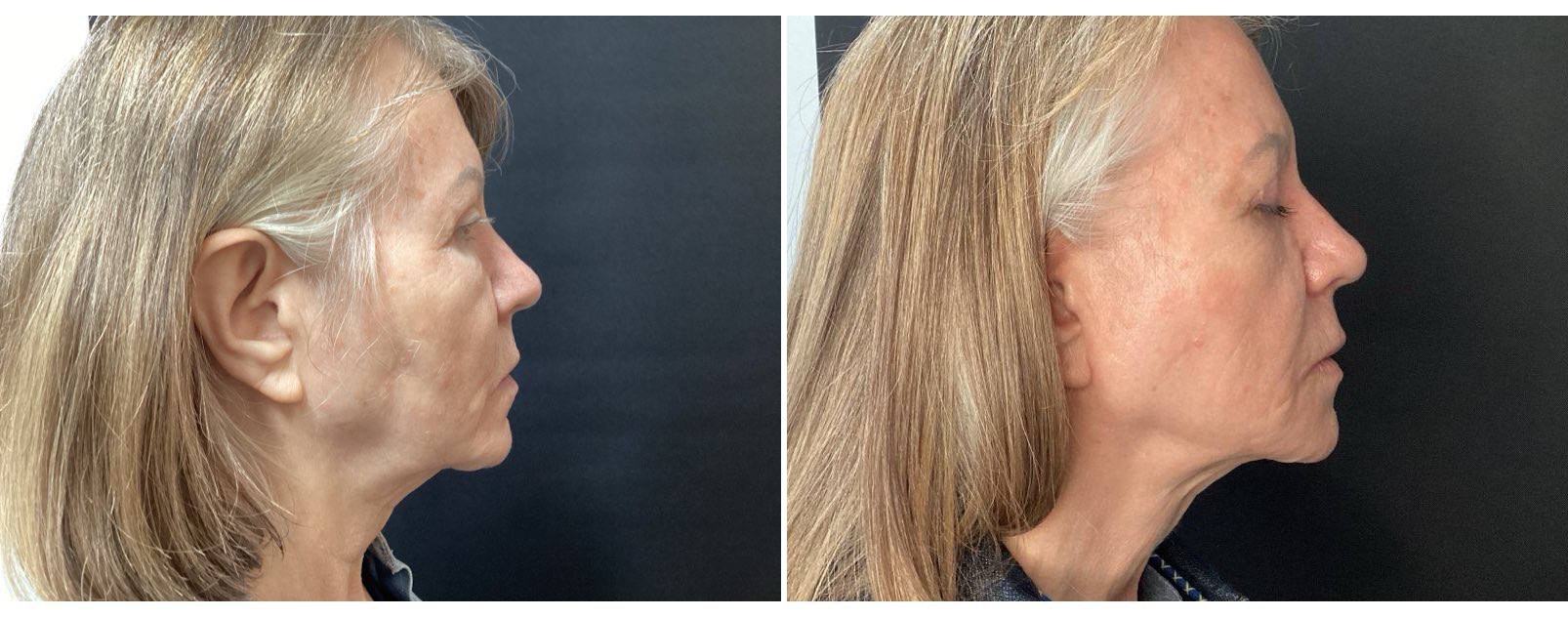 Firmer jawline & neck after Ultherapy® — actual Juniper patient. Individual results vary.