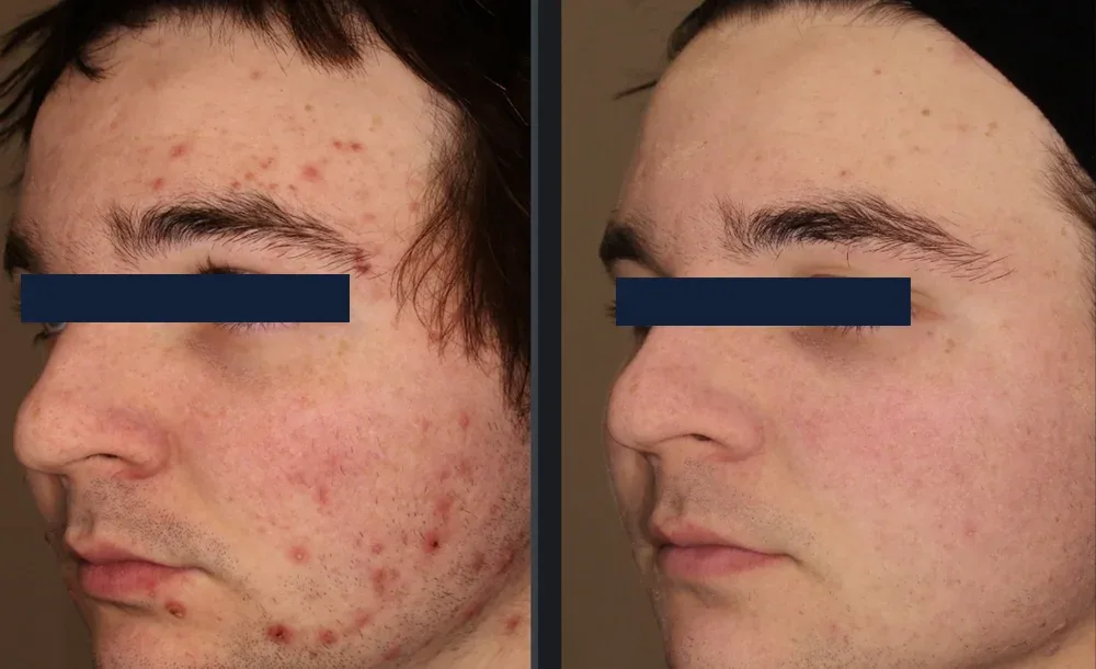 Inflamed acne and post-acne redness cleared after a series of three VBeam&reg; treatments. Representative manufacturer clinical case courtesy of Gilly Munavalli, MD Individual results vary.