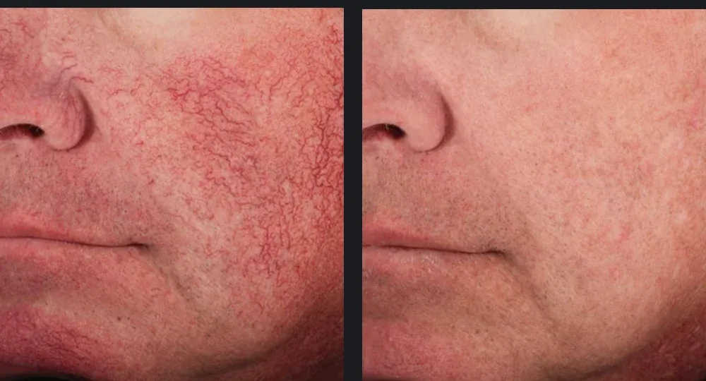 Dense facial spider veins cleared after four VBeam&reg; treatments. Representative manufacturer clinical case courtesy of Eric Bernstein, MD Individual results vary.
