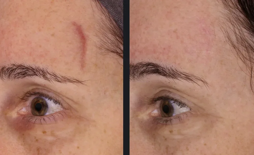 Raised red scar faded and flattened after two VBeam&reg; treatments. Representative manufacturer clinical case courtesy of Gilly Munavalli, MD Individual results vary.