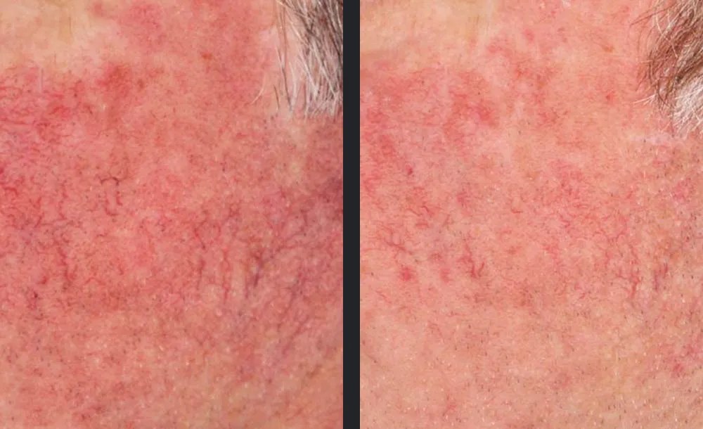 Diffuse redness & visible vessels reduced after VBeam®. Representative manufacturer clinical image (Candela VBeam Prima&trade;) — individual results vary.