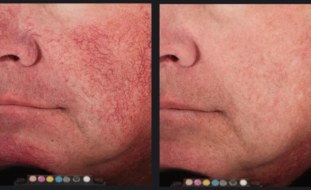 Facial veins & broken capillaries cleared after VBeam®. Representative manufacturer clinical image (Candela VBeam Prima&trade;, courtesy E. Bernstein, MD) — individual results vary.