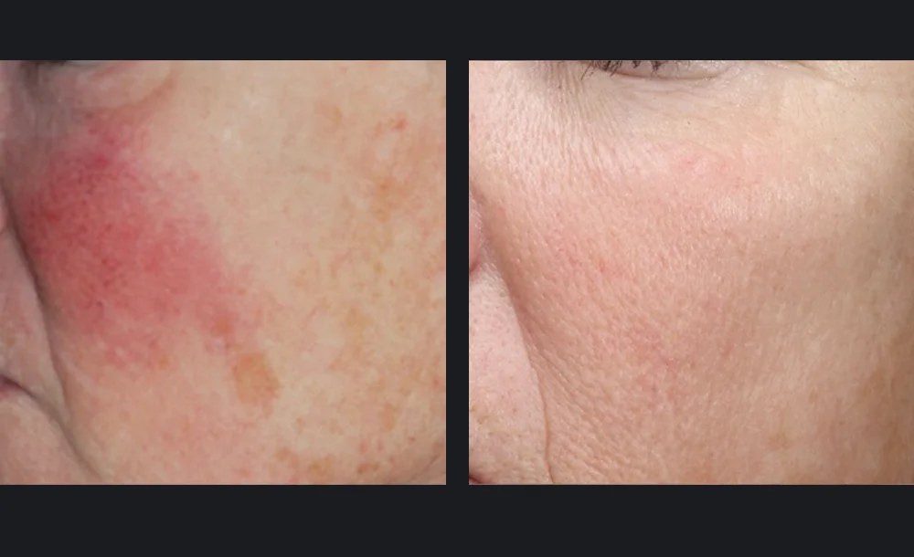Rosacea & facial redness calmed after VBeam® (2 treatments). Representative manufacturer clinical image (Candela VBeam Prima&trade;) — individual results vary.