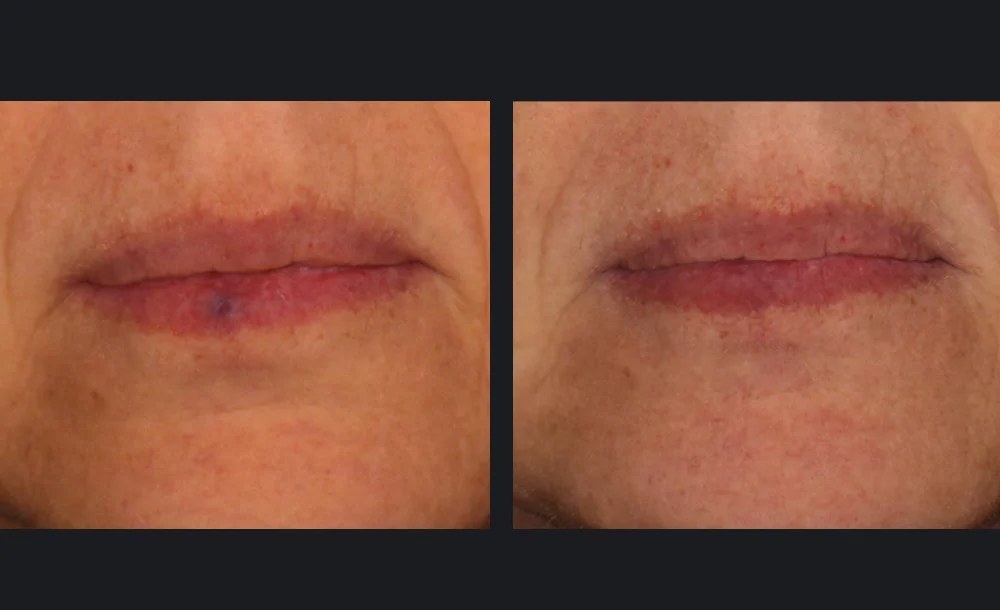 Vascular lesion (venous lake) on the lip cleared after VBeam® (1 treatment). Representative manufacturer clinical image (Candela VBeam Prima&trade;, courtesy G. Munavalli, MD) — individual results vary.