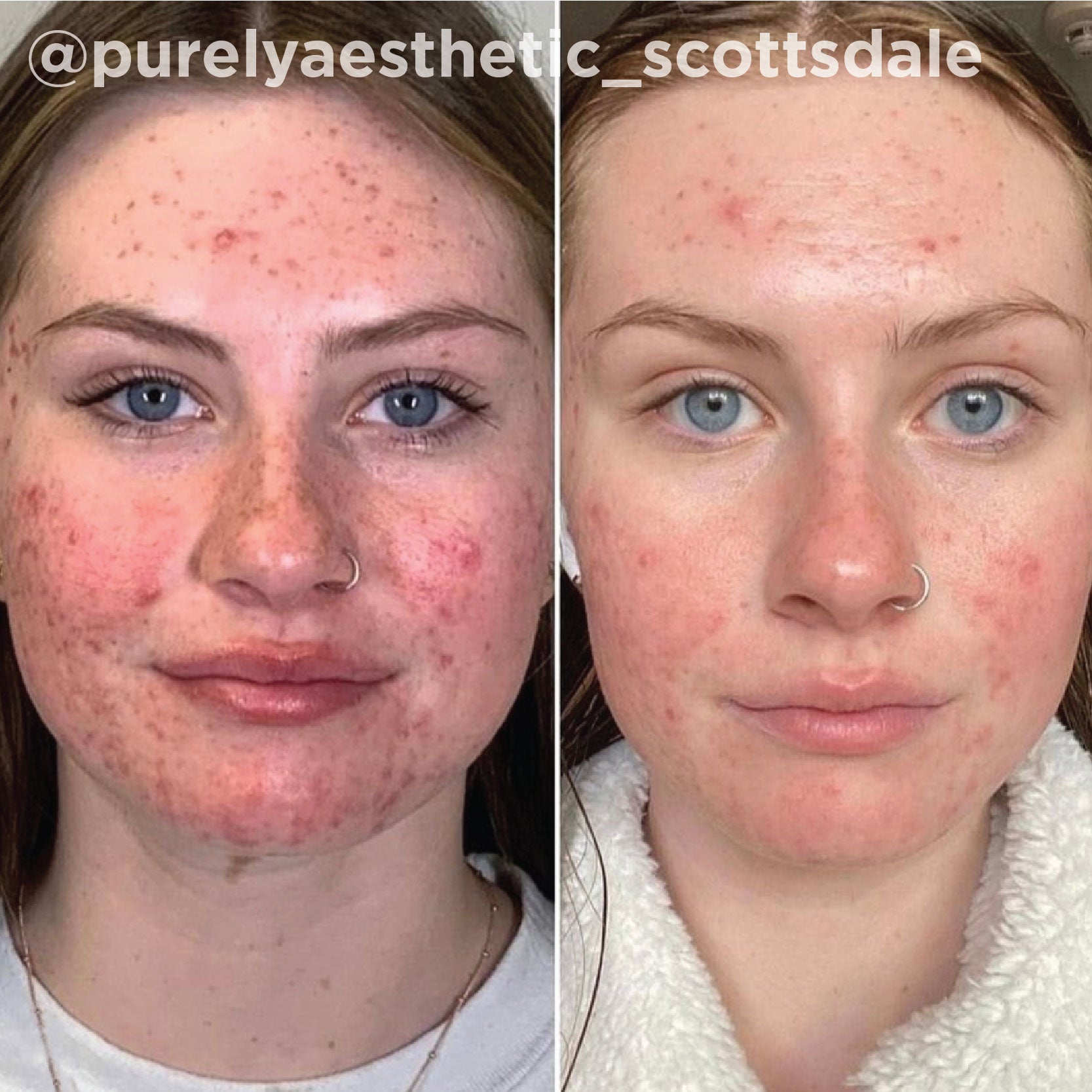 Post-acne marks, redness and congestion cleared after a series of VI Peel&reg; treatments. Representative manufacturer clinical case (VI Peel&reg; by the Vitality Institute); not a Juniper patient. Individual results vary.