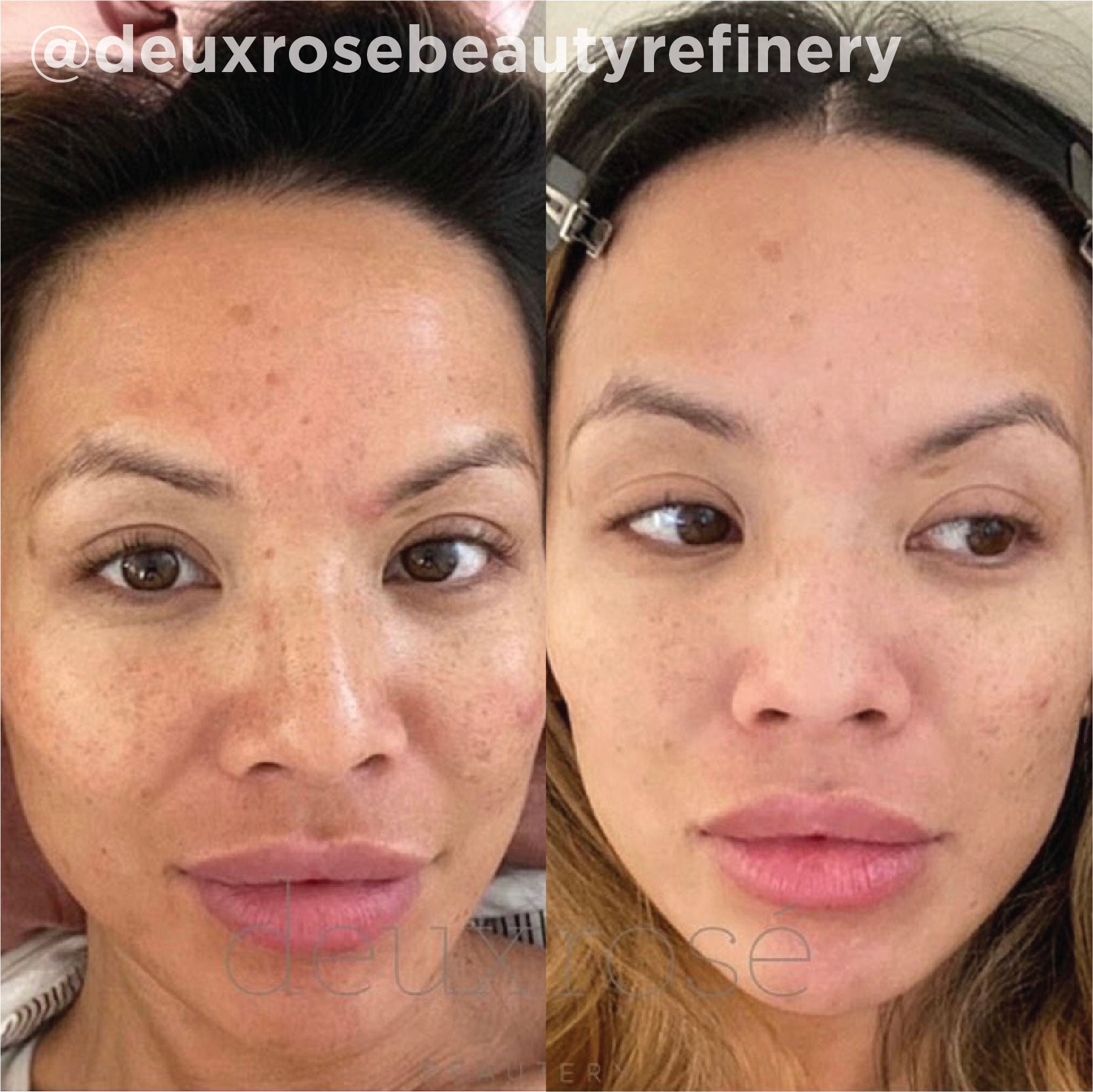Sun-induced pigmentation and uneven tone improved after a series of VI Peel&reg; treatments. Representative manufacturer clinical case (VI Peel&reg; by the Vitality Institute); not a Juniper patient. Individual results vary.