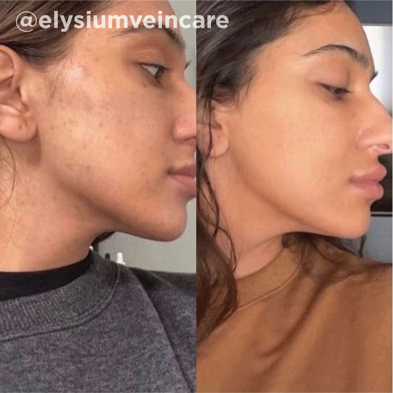 Rough texture and congestion refined after a series of VI Peel&reg; treatments. Representative manufacturer clinical case (VI Peel&reg; by the Vitality Institute); not a Juniper patient. Individual results vary.